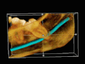 Hình 6: Răng mọc đè dây thần kinh hô hấp (xanh lam) ở người bệnh bị đau răng kèm theo rối loạn hô hấp. Ảnh đã xử lí photoshop