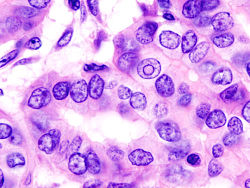 صورة مجهرية (عرض عالي الطاقة) من حليمي سرطان الغدة الدرقية مما يدل على ملامح التشخيص (المقاصة النووية ونوى المتداخلة). صبغة الهيماتوكسيلين والأيوزين.