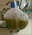 Orina verdosa durant una infusió prolongada de propofol.