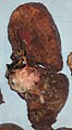 Isang squamous cell carcinoma (ang maputing tumor) malapit sa bronchi isang specimen ng baga.