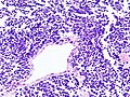 Histopathologic image of small-cell carcinoma of the lung. CT-guided core needle biopsy.