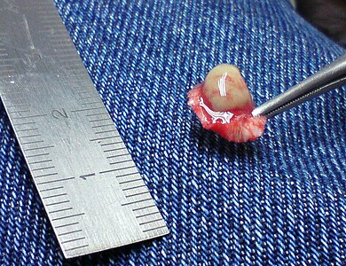 Una berruga plantar de 7 mm retirada quirúrgicament de la planta del peu d'una persona després que altres tractaments fracasssin
