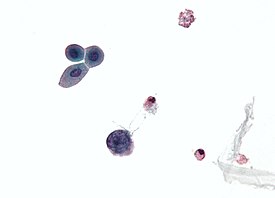 Микрофотография клетки, инфицированной полиомавирусом — крупная синяя клетка слева, ниже центра. Образец мочи