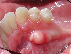 حيد الفك السفلي في منطقة الأسنان قبل الطاحنة.