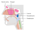 Stage T2 nasopharyngeal cancer