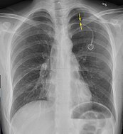 Anteroposterior inspired X-ray, showing subtle left-sided pneumothorax caused by port insertion