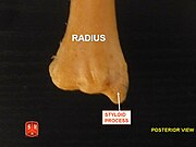 Radius, ulnar notch - posterior view(Arkadan)