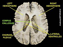 Corpus callosum