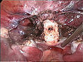 Zervixstumpf (weiß) nach Entfernung des Gebärmutterkörpers bei der laparoskopischen suprazervikalen Hysterektomie (LASH)