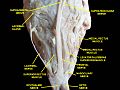 Muscle oculaire extrinsèque. Nerfs de l'orbite. Dissection profonde.