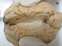 左の拡大。二つの大脳半球の間をつなぐ白い部分が脳梁。
