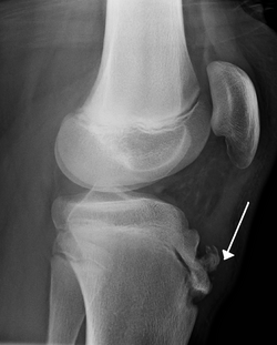 منظر جانبي للركبة بالأشعة السينية، يُظِهر تجزؤ أحدوبة الظنبوب وتورم حاد في الأنسجة الرخوة.