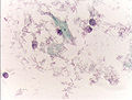 the cytoplasms of squamous epithelial cells melted out; many Döderlein bacilli can be seen