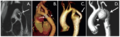 Aortic coarctation using different imaging techniqes[16]