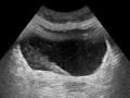 Ultrasound showing a jet of urine entering the bladder (large black section) through the ureter