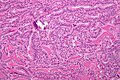 Micrograph of papillary thyroid carcinoma, tall cell variant - intermediate magnification. H&E stain.