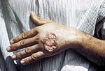 Cutaneous leishmaniasis e letsohong la motho e moholowa Amerika Bohareng