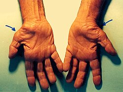 Kéztőalagút-szindróma a kezelés előtt. A hüvelykujj tövében lévő izmok sorvadása (atrófia) látható