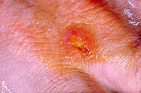 Tularémia fertőzés emberi kézen