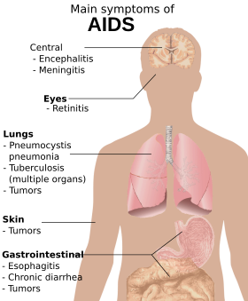 A diagram of a human torso labeled with the most common symptoms of AIDS