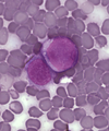February 16: Leukemia cells.