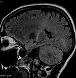 ALS-potilaan aivojen magneettikuva.