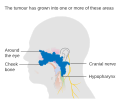 Stage T4 nasopharyngeal cancer