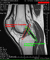 Krucijatni ligamenti