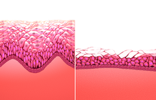 Histologien einer prämenopausalen und einer postmenopausalen Vaginalmucosa