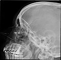 Paranasal sinuses radiograph (lateral)