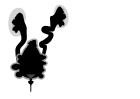 Posterior urethral valves - easily mistaken for cystic renal disease on early scans; appearances are due to obstruction not cysts