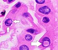 Nuclear pseudoinclusions, which are invaginations of cytoplasm into the nucleus.[23]