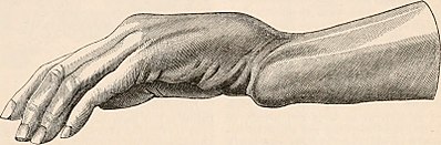 Dorsal displacement of carpal bones seen in dorsally angulated distal radius fracture, creating a fork-like appearance