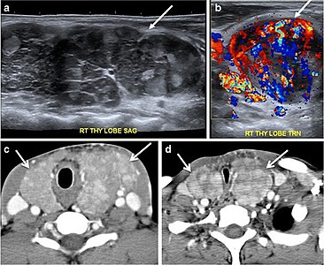 Fig. 14. A 19-year-old male patient known to have multi-nodular goiter and FNA, showing underlying Hashimoto's thyroiditis. a, b Sagittal and transverse greyscale and colour Doppler ultrasound of the neck demonstrate a hypoechoic enlarged right thyroid lobe with small hyperechoic regenerative nodules and marked hypervascularity (white arrows). c, d Enhanced axial CT scan images of the neck demonstrate a heterogeneously enhancing and enlarged thyroid gland, left more than right lobe, and the trachea is markedly narrowed.[1]