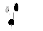 Pelvi-ureteric junction obstruction - easily mistaken for cystic renal disease on early scans