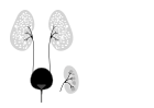 Autosomal recessive polycystic kidney disease