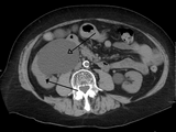 Massive hydronephrosis as marked by the arrow