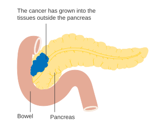 Štádium T3 karcinómu pankreasu