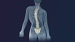 3D Medical Animation still shot of Scoliosis