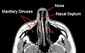 MRI image showimg nasal septum.