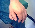 Polydaktylia u 27-letniego mężczyzny; w palcu nie ma stawów, przez co pozbawiony jest możliwości ruchu