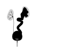 High grade vesico-ureteric reflux - easily mistaken for cystic renal disease on early scans