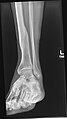 X-ray avulsion fracture of the summit of the left lateral malleolus.