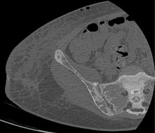 Subchondral resorption in the sacroiliac joint.[18]