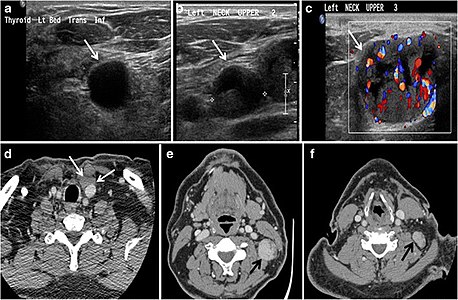 Fig. 9. A 58-year-old male patient with persistence PTC at thyroid bed with hypervascular nodal metastasis. a–c Transverse greyscale and colour Doppler neck ultrasound demonstrate hypoehoic soft tissue in the left thyroid bed (white arrow in a). There are a heterogeneous enlarged lymph nodes at level 2 and 3 with markedly increased vascularity (white arrow in b and c). d–f Enhanced axial CT images of the neck demonstrate a 2.7 × 1.4 cm hypodense soft tissue lesion anterior to the left carotid sheath (white arrow). There are left-sided enhancing abnormal and enlarged lymph nodes at cervical level 2 and 3 (black arrows).[1]