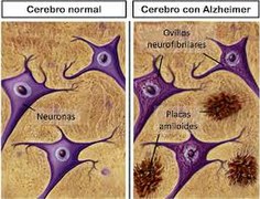 burmuin osasuntsu baten eta alzheimerra duen burmuin baten alderaketa