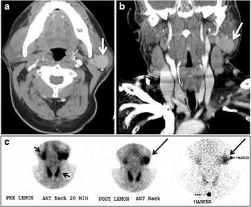 Fig. 17. Ectopic thyroid on the left parotid gland with a palpable left parotid mass in a 69-year-old male patient. a, b Axial and coronal enhanced neck CT scan demonstrates well-defined homogeneous enhancing mass (white arrows) within the left parotid gland with preserved surrounding fat planes. It also shows a normal thyroid in normal position in the lower neck. c Image taken 20 minutes after 5 mCi injected Tc99m-Pertechnetate shows normal thyroid uptake of tracer and physiological uptake in the salivary glands (short black arrow). There is a distinct focus of abnormal tracer accumulation in the left parotid/submandibular region. Patient was given lemon juice with evident normal washout from the salivary glands and relative retention by this abnormal focus (long black arrow).[1]