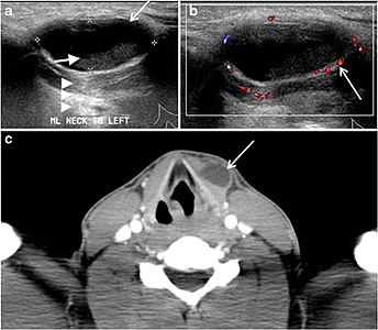 Fig. 19. Long-standing infected thyroglossal duct cyst in a 29-year-old male patient. a Transverse greyscale ultrasound at midline, just above the level of the thyroid gland, shows an oval cystic lesion with internal echoes (white arrows) and posterior enhancement (arrowheads). b Transverse colour Doppler ultrasound shows surrounding peripheral flow (white arrow). c Axial enhanced neck CT scan at the level of the thyroid cartilage demonstrates a slightly off-midline, well-defined, homogeneous cystic lesion embedded in the left strap muscle with peripheral enhancement (white arrow). It shows no calcification or internal enhancement. Thyroid gland was normal (not shown).[1]