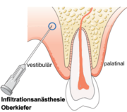 Penetration der Kanüle einer Betäubungsspritze für die Lokalanästhesie in der Zahnmedizin