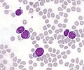 T-lymphoblastic cells of acute leukemia in the bone marrow